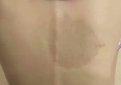 ​如何早期识别局限性硬皮病？一文说清（内附图片）