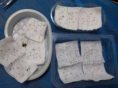 ​好可怕！遂昌一农妇被蜂群袭击，身上挑出400多根刺